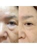 最強骨気(コルギ)目の下、ほうれい線、マリオネット線、改善コース