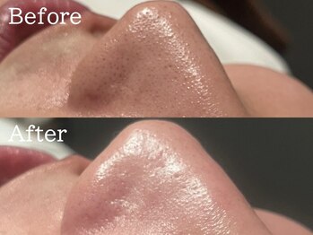 セレブリボーン 大阪ボーテ/ハイドロ毛穴洗浄