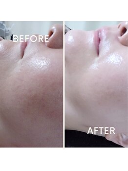 ニコリー(nicoly)/イオン導入◎before→after