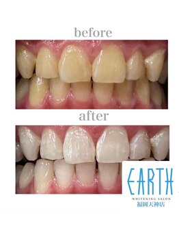 アース 福岡天神店(EARTH)/before　after　【美白