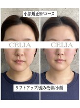 セリア(CELIA)/小顔矯正/小顔//面長/エラ張り