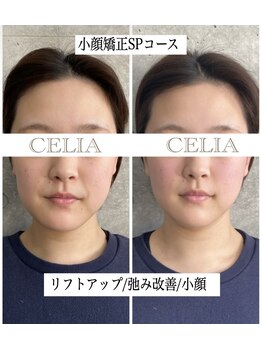 セリア(CELIA)/小顔矯正/小顔//面長/エラ張り