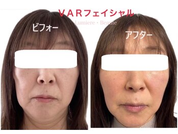 リュミエールボーテ/《NEW！》ＶＡＲフェイシャル