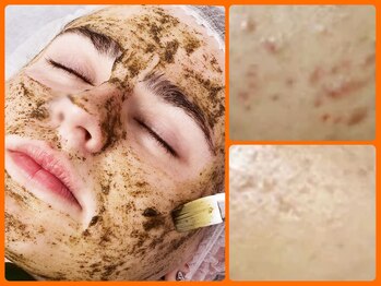 スイ 昭島店(Sui)/ハーブピーリング/ニキビケア