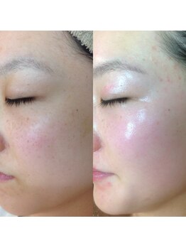 エステ ド モモコ/ハーブピーリング