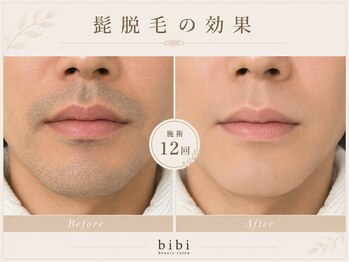 ビビ(bibi)/メンズヒゲ脱毛施術12回