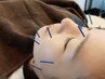 【美容鍼全4回お得コース】全身整体＋美容鍼44000円→40000円60分
