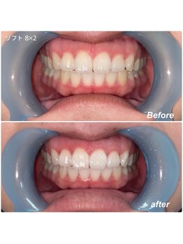 アンヴィオ ギンザコウフ(Anvio GINZA KOFU)/セルフホワイトニング