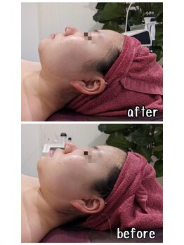 ファビリス 仙台ロフト店(FAVILIS)/【フェイシャル】ハイパー2回目