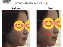 ベル/20代の方の小顔Before After