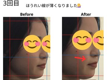 ベル/20代の方の小顔Before After