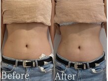 サージュクロレ 松戸店(sage colorer)/ハイパーナイフ痩身