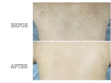 リス ブラン(Lys Blanc)/ハーブピーリング背中ＣＡＲＥ