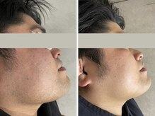 メンズ脱毛＆ヘッドスパ MEN'S with Lilina. 新横浜［ヒゲ脱毛/全身脱毛/VIO脱毛］/フェイスラインケア/小顔/新横浜