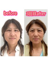 ハーボプラス(THE HEARBO plus)/小顔になり過ぎてます！