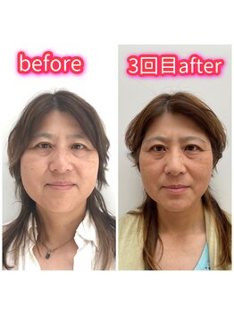 ハーボプラス(THE HEARBO plus)/小顔になり過ぎてます!