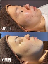 ケーナインエッセ(K9 esse)/ハーブピーリングBefore→After