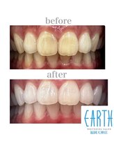 アース 福岡天神店(EARTH)/before　after　【美白