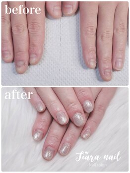 ティアラネイル 宇都宮/リプロネイル深爪矯正