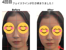 ベル/20代の方の小顔Before After