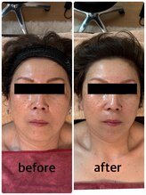 シュガー(Sugar...iyr)/【REVI】陶肌トリートメント初回