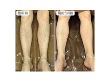 トパーズ 藤枝店(Topaz)/脚脱毛　清潔感UP VIOも施術◎