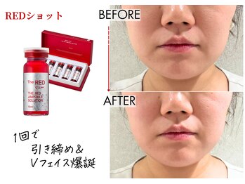 キレイベース 銀座店(KIREI BASE)/レッドショット 1回での変化