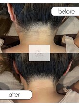 シェール(Cher)/他では出来ない襟足脱毛