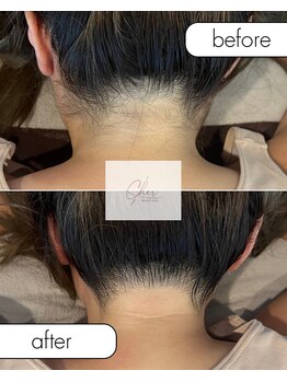 シェール(Cher)/他では出来ない襟足脱毛