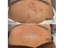 大人気のハーブピーリング(剥離なし)