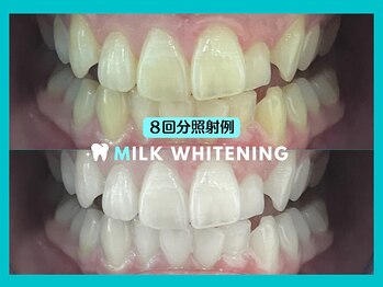 ミルクホワイトニング 久留米店(Milkホワイトニング)/★施術例