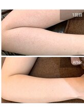 ビビ(VIVI)/二の腕毛孔性苔癬