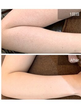 ビビ(VIVI)/二の腕毛孔性苔癬