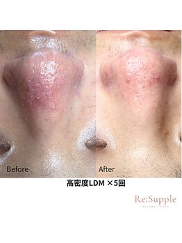 リサプリ(Re: Supple)/毛細血管拡張による赤みを鎮静化