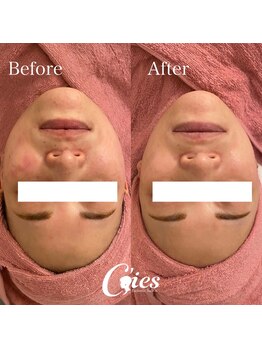 シーズ(C'ies)/最新小顔Vラインリフト
