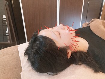 アキュティ 吉祥寺(Acuty)/小顔美容鍼