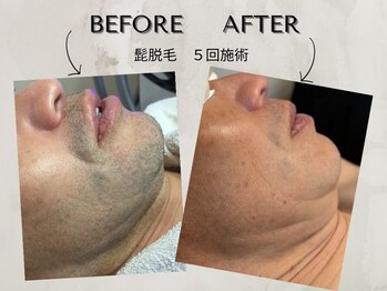 ワンアップ(One-up)/ヒゲ脱毛 5回　before　after