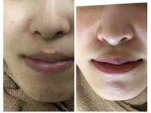 モカ 天王寺店(MOKA)/顎ニキビ　ハーブピーリング