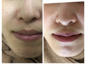 モカ 天王寺店(MOKA)/顎ニキビ　ハーブピーリング