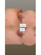 フットミー(foot mii)/たるみ・毛穴・シミ・くすみ