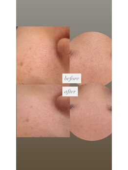 フットミー(foot mii)/たるみ・毛穴・シミ・くすみ