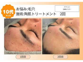 ムーンサン(Moon sun)/10代メンズ　陶肌トリートメント