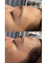 ジル(JilL)/水光ピールビフォーアフター