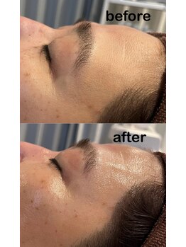 ジル(JilL)/水光ピールビフォーアフター