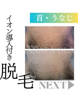 アナパ・オラ/脱毛