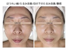 グロウ バイ フェイシャルデザイン アンド アイ(GROW)の雰囲気（40代～のお悩み、たるみケア/ほうれい線/マリオネットライン改善）