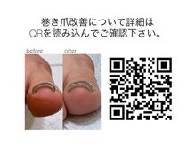 クオン(KUON)/巻き爪改善コース