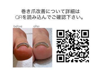 クオン(KUON)/巻き爪改善コース