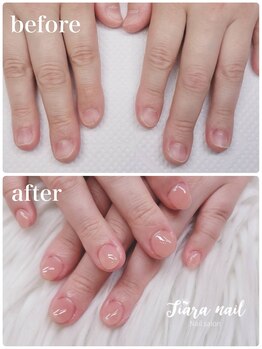 ティアラネイル 宇都宮/リプロネイル深爪矯正コース