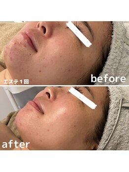 デラッセ(Delasser salon)/ハーブピーリング